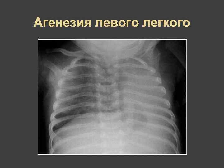 Агенезия левого легкого 