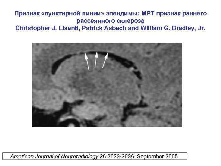 Признак «пунктирной линии» эпендимы: МРТ признак раннего рассеянного склероза Christopher J. Lisanti, Patrick Asbach