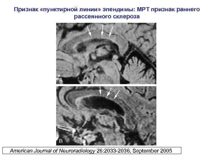 Признак «пунктирной линии» эпендимы: МРТ признак раннего рассеянного склероза American Journal of Neuroradiology 26: