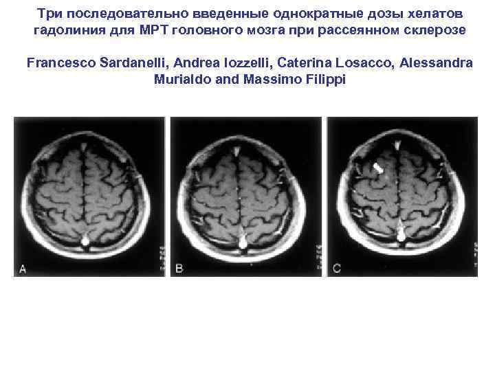 Три последовательно введенные однократные дозы хелатов гадолиния для МРТ головного мозга при рассеянном склерозе