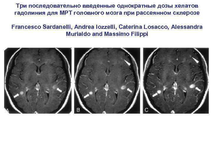 Три последовательно введенные однократные дозы хелатов гадолиния для МРТ головного мозга при рассеянном склерозе