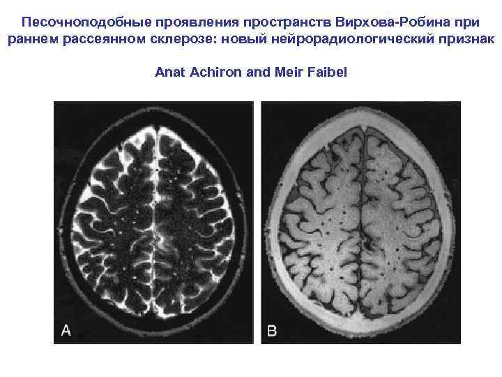 Песочноподобные проявления пространств Вирхова-Робина при раннем рассеянном склерозе: новый нейрорадиологический признак Anat Achiron and