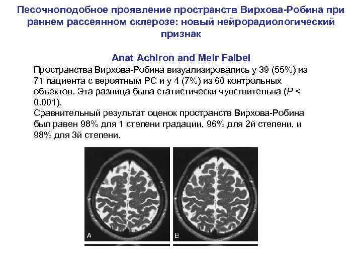 Песочноподобное проявление пространств Вирхова-Робина при раннем рассеянном склерозе: новый нейрорадиологический признак Anat Achiron and