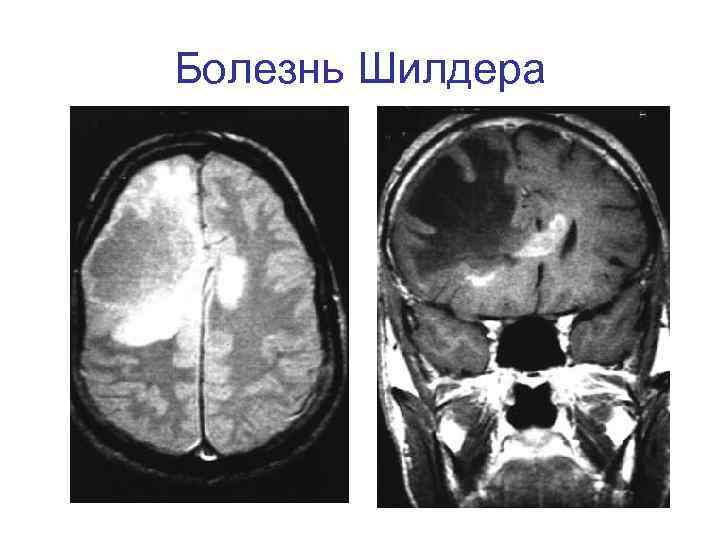 Болезнь Шилдера 