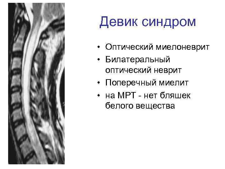 Девик синдром • Оптический миелоневрит • Билатеральный оптический неврит • Поперечный миелит • на