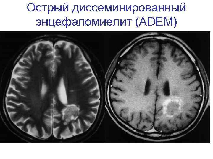 Острый диссеминированный энцефаломиелит (ADEM) 