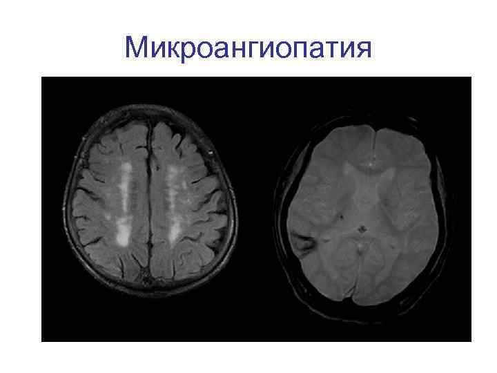 Микроангиопатия 