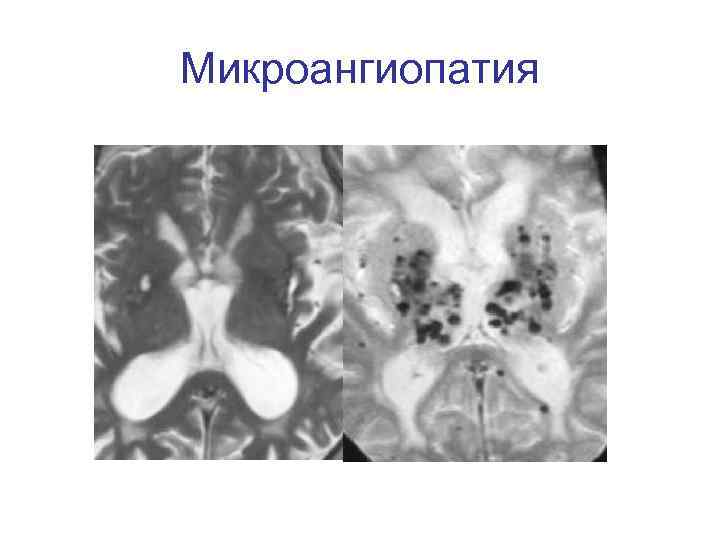 Микроангиопатия 