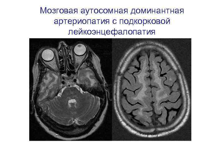 Мозговая аутосомная доминантная артериопатия с подкорковой лейкоэнцефалопатия 