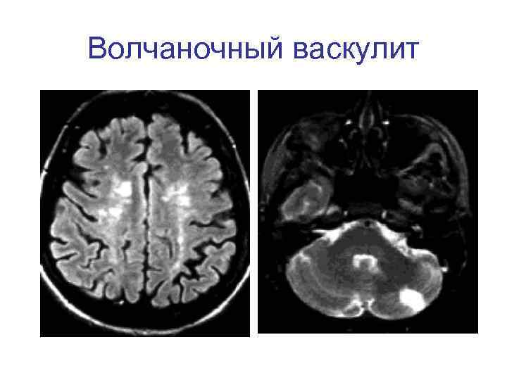 Волчаночный васкулит 