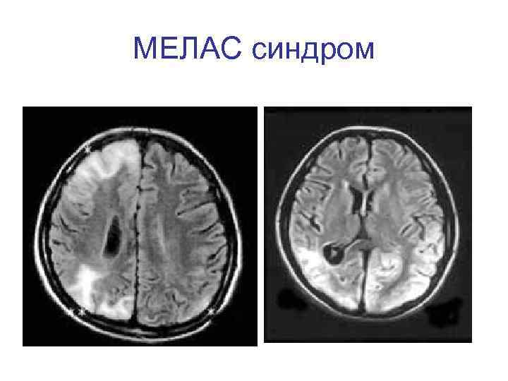 МЕЛАС синдром 
