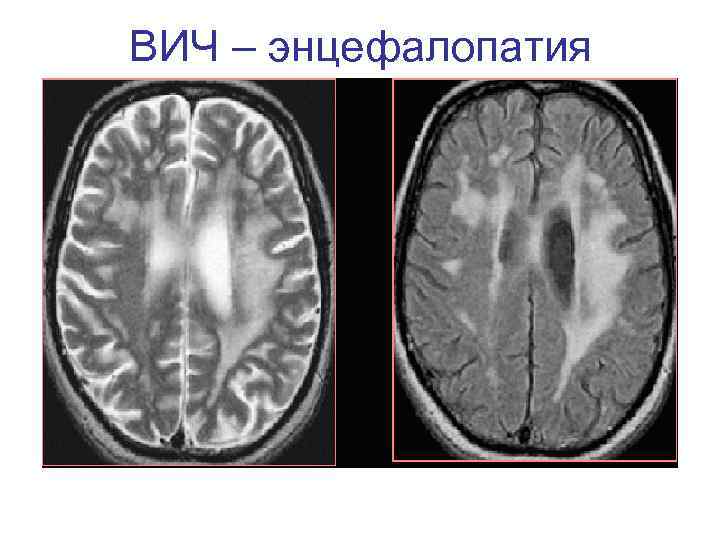 ВИЧ – энцефалопатия 