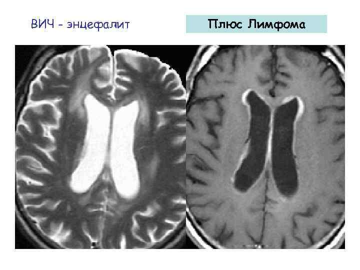 ВИЧ - энцефалит Плюс Лимфома 