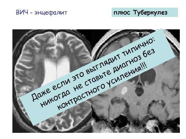 ВИЧ - энцефалит плюс Туберкулез о: чн пи ез ти з б ит но