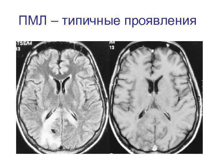 ПМЛ – типичные проявления 