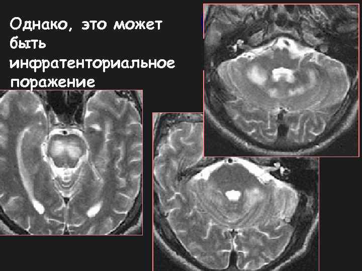 Однако, это может быть инфратенториальное поражение 