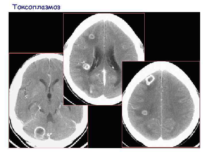 Токсоплазмоз 