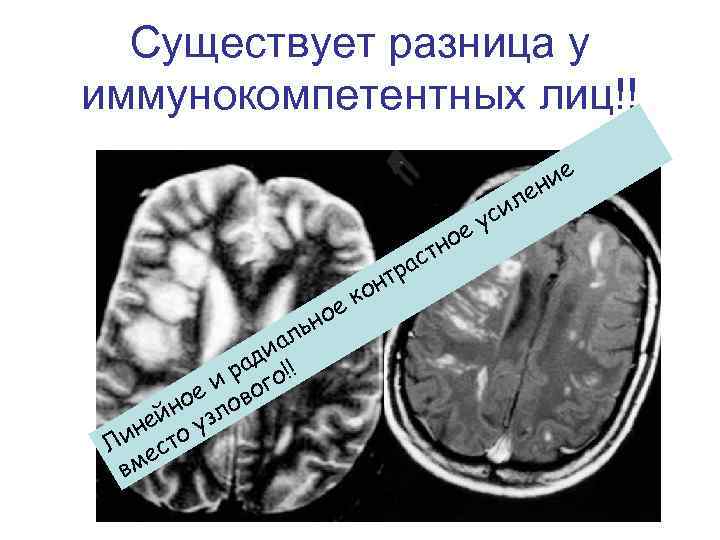Существует разница у иммунокомпетентных лиц!! ус е л иа д ра о!! е и