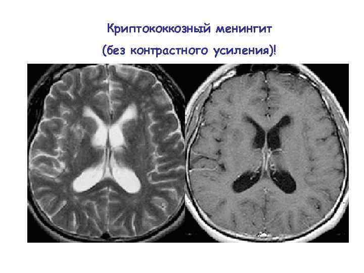 Криптококкозный менингит (без контрастного усиления)! 