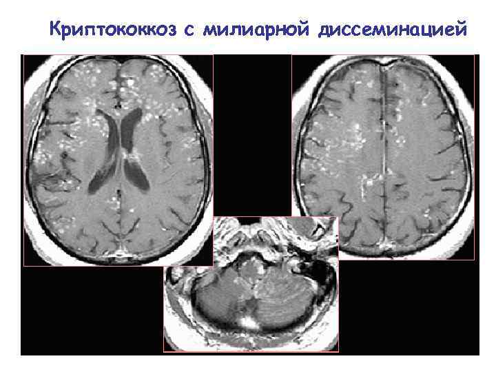 Криптококкоз с милиарной диссеминацией 