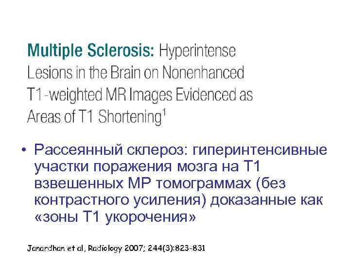  • Рассеянный склероз: гиперинтенсивные участки поражения мозга на Т 1 взвешенных МР томограммах