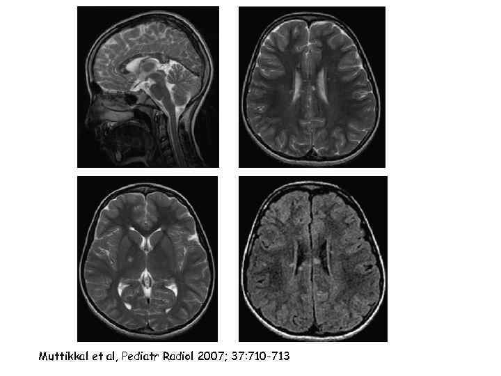 Muttikkal et al, Pediatr Radiol 2007; 37: 710 -713 
