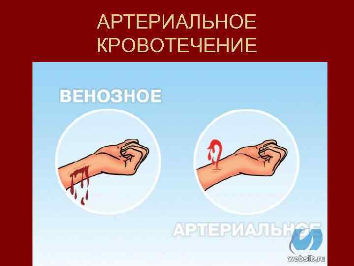 АРТЕРИАЛЬНОЕ КРОВОТЕЧЕНИЕ 