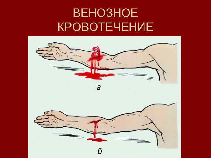  ВЕНОЗНОЕ КРОВОТЕЧЕНИЕ 
