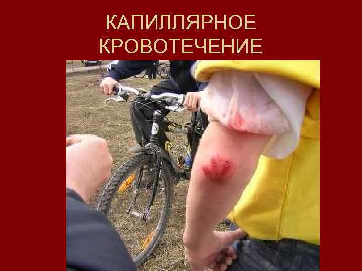  КАПИЛЛЯРНОЕ КРОВОТЕЧЕНИЕ 
