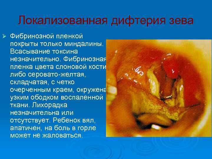  Локализованная дифтерия зева Ø  Фибринозной пленкой покрыты только миндалины. Всасывание токсина незначительно.