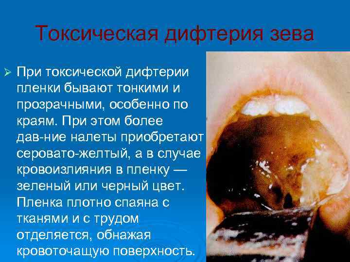  Токсическая дифтерия зева Ø  При токсической дифтерии пленки бывают тонкими и прозрачными,