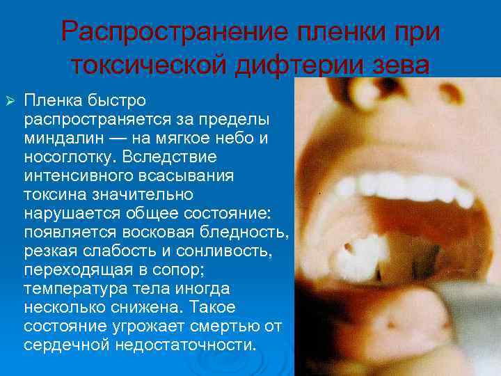   Распространение пленки при   токсической дифтерии зева Ø  Пленка быстро