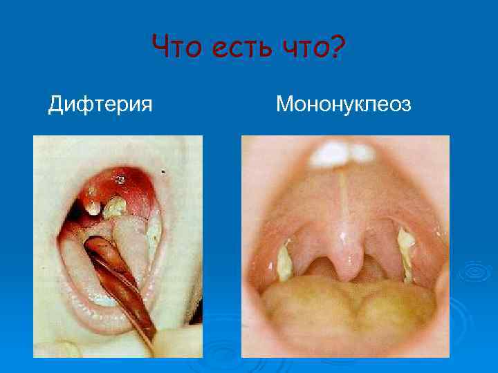   Что есть что? Дифтерия  Мононуклеоз 