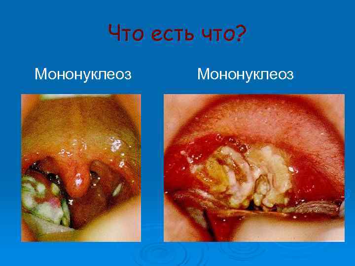   Что есть что? Мононуклеоз 