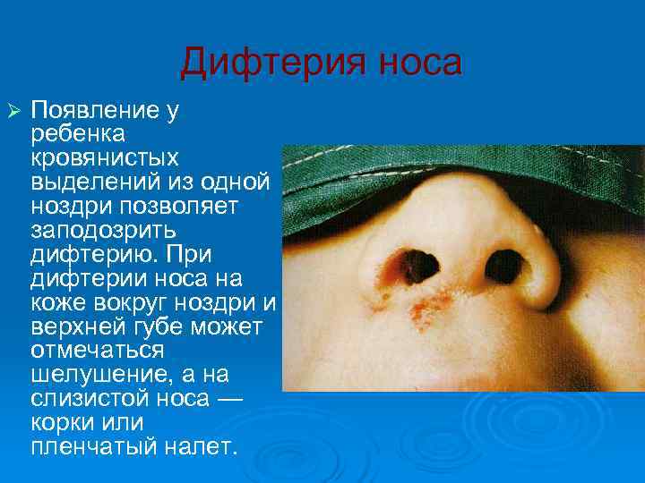     Дифтерия носа Ø  Появление у ребенка кровянистых выделений из