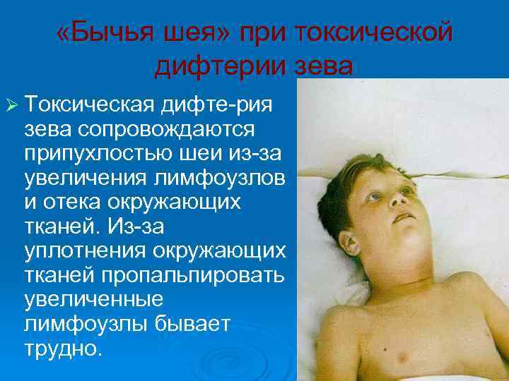  «Бычья шея» при токсической  дифтерии зева Ø Токсическая дифте рия зева сопровождаются