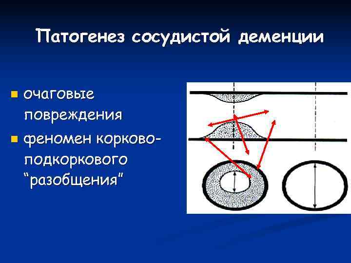  Патогенез сосудистой деменции  n  очаговые повреждения n  феномен корково- подкоркового