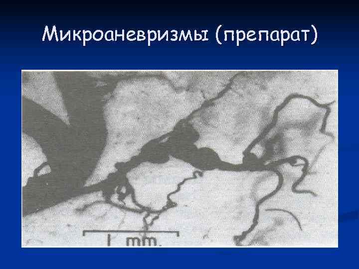 Микроаневризмы (препарат) 