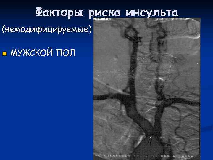   Факторы риска инсульта (немодифицируемые) n  МУЖСКОЙ ПОЛ 