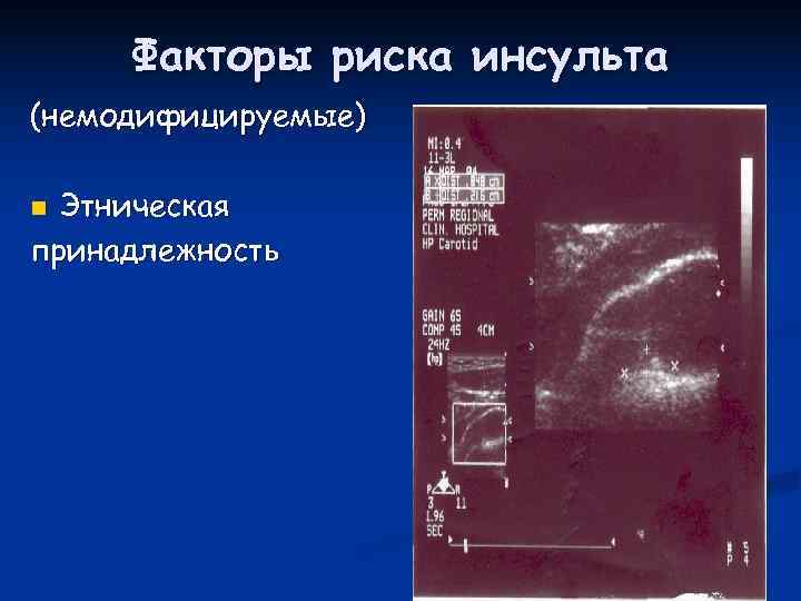  Факторы риска инсульта (немодифицируемые) n Этническая принадлежность 