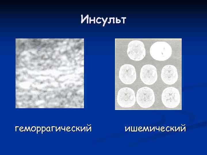   Инсульт геморрагический  ишемический 
