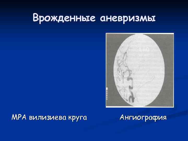  Врожденные аневризмы МРА вилизиева круга  Ангиография 