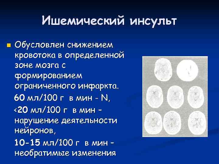    Ишемический инсульт n  Обусловлен снижением кровотока в определенной зоне мозга