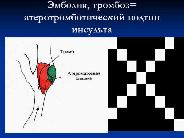  Эмболия, тромбоз= атеротромботический подтип   инсульта 