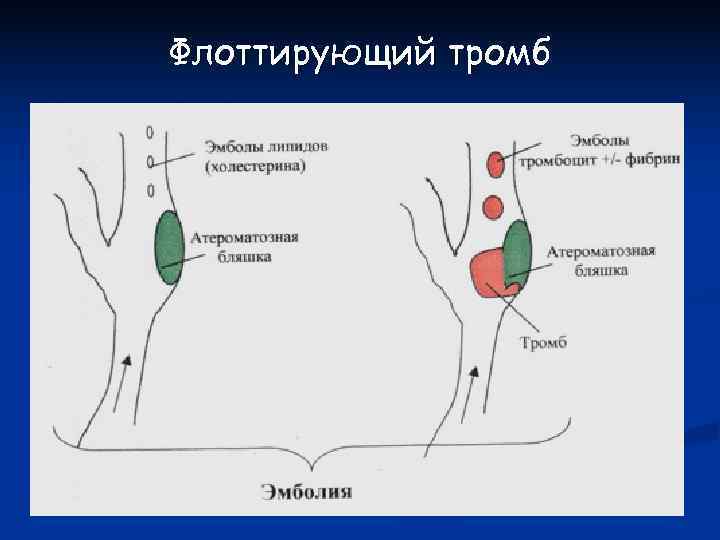 Флоттирующий тромб 
