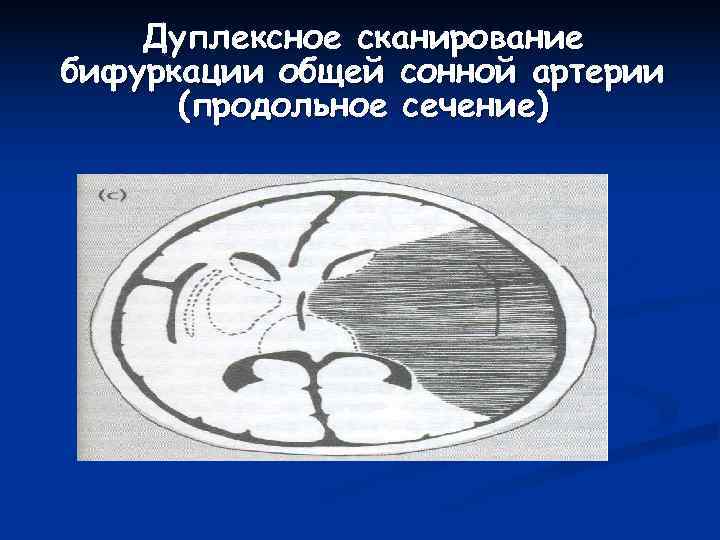   Дуплексное сканирование бифуркации общей сонной артерии  (продольное сечение) 