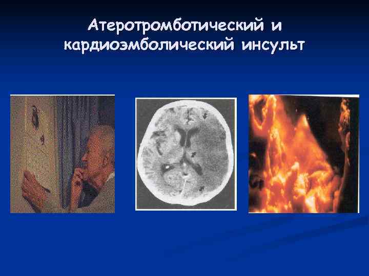   Атеротромботический и кардиоэмболический инсульт 