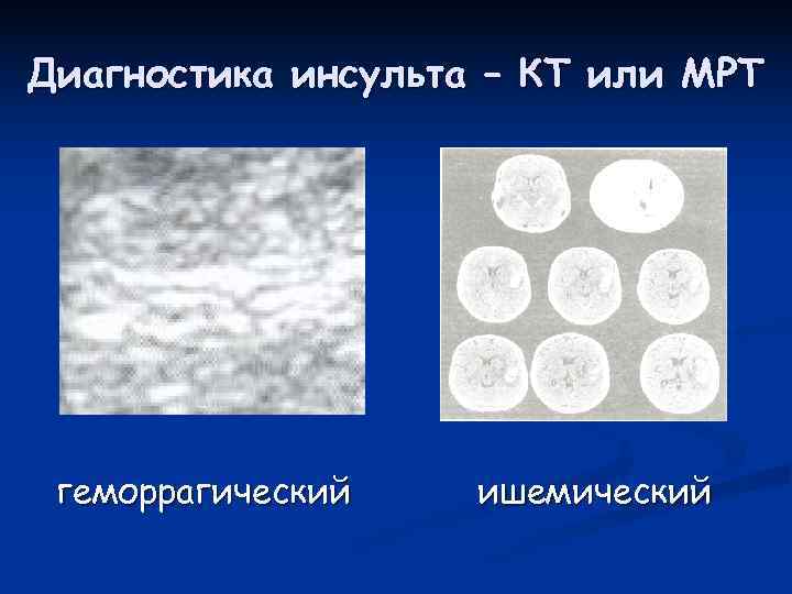 Диагностика инсульта – КТ или МРТ геморрагический  ишемический 