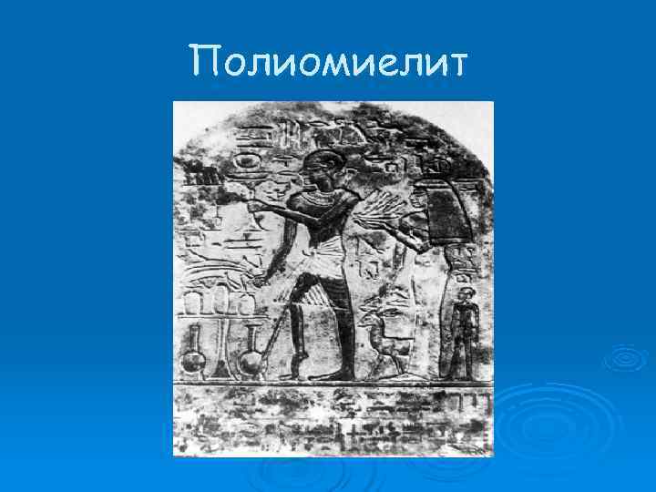 Полиомиелит 