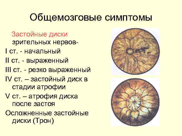   Общемозговые симптомы  Застойные диски  зрительных нервов- I ст. - начальный